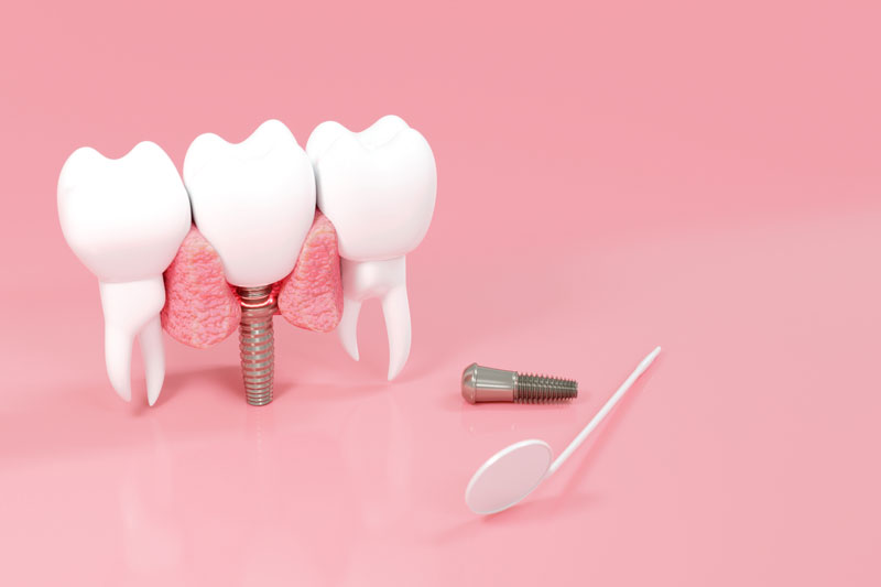 a dental implant with 2 teeth surrounding it and a mirror to the right