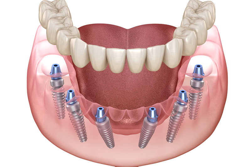all on 6 dental implants with a full arch of teeth across them
