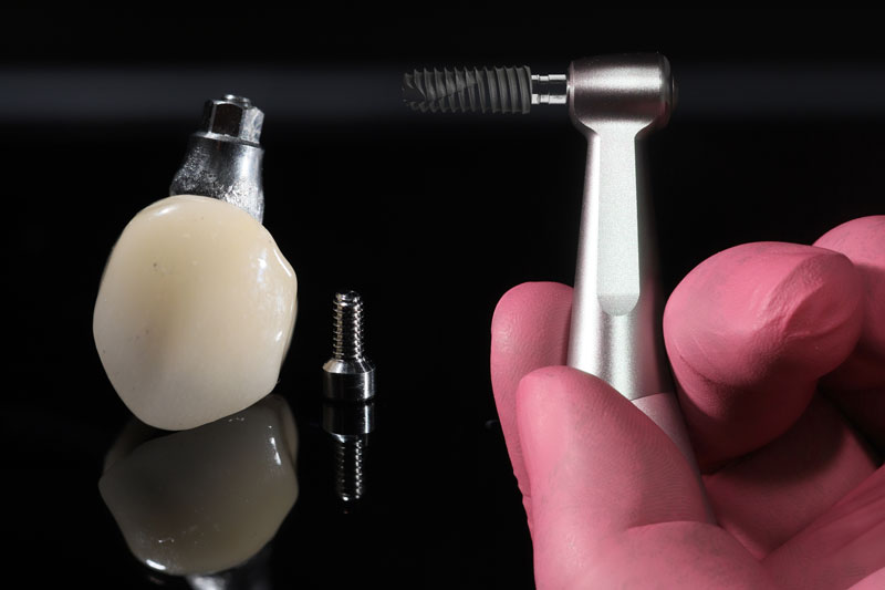 a single dental implant with a doctor holding up a tool for placement