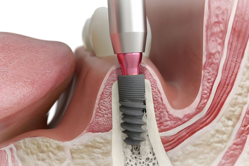 a dental implant cut away with clear illustrations of the jaw bone and the gum line