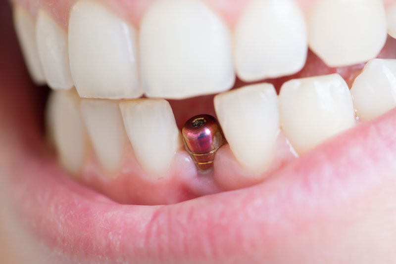 a patient with a dental implant in his mouth that needs a crown