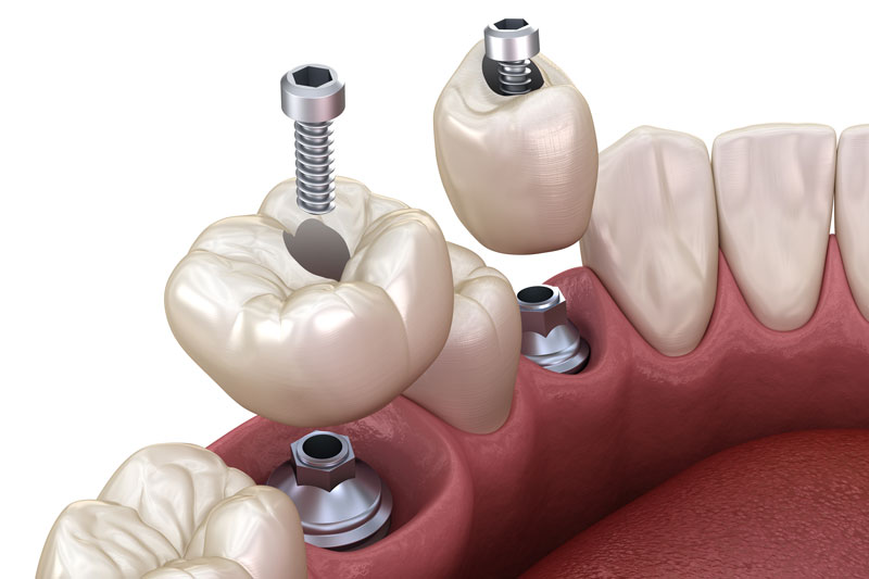 2 single dental implants with crowns on top of the implants/abutments