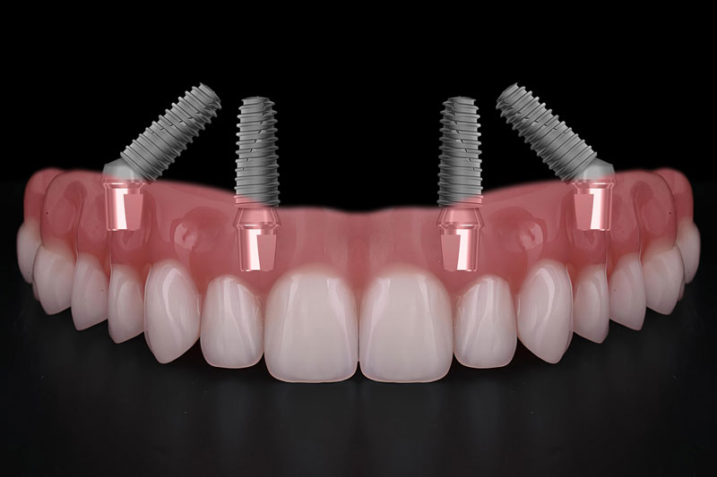all on 4 dental implants with a full arch going across them