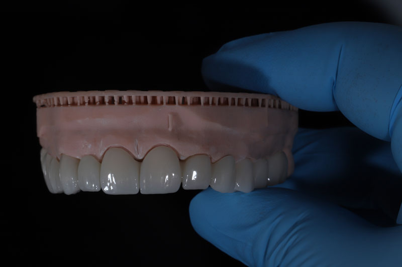 dental implants with a full arch of teeth going across it