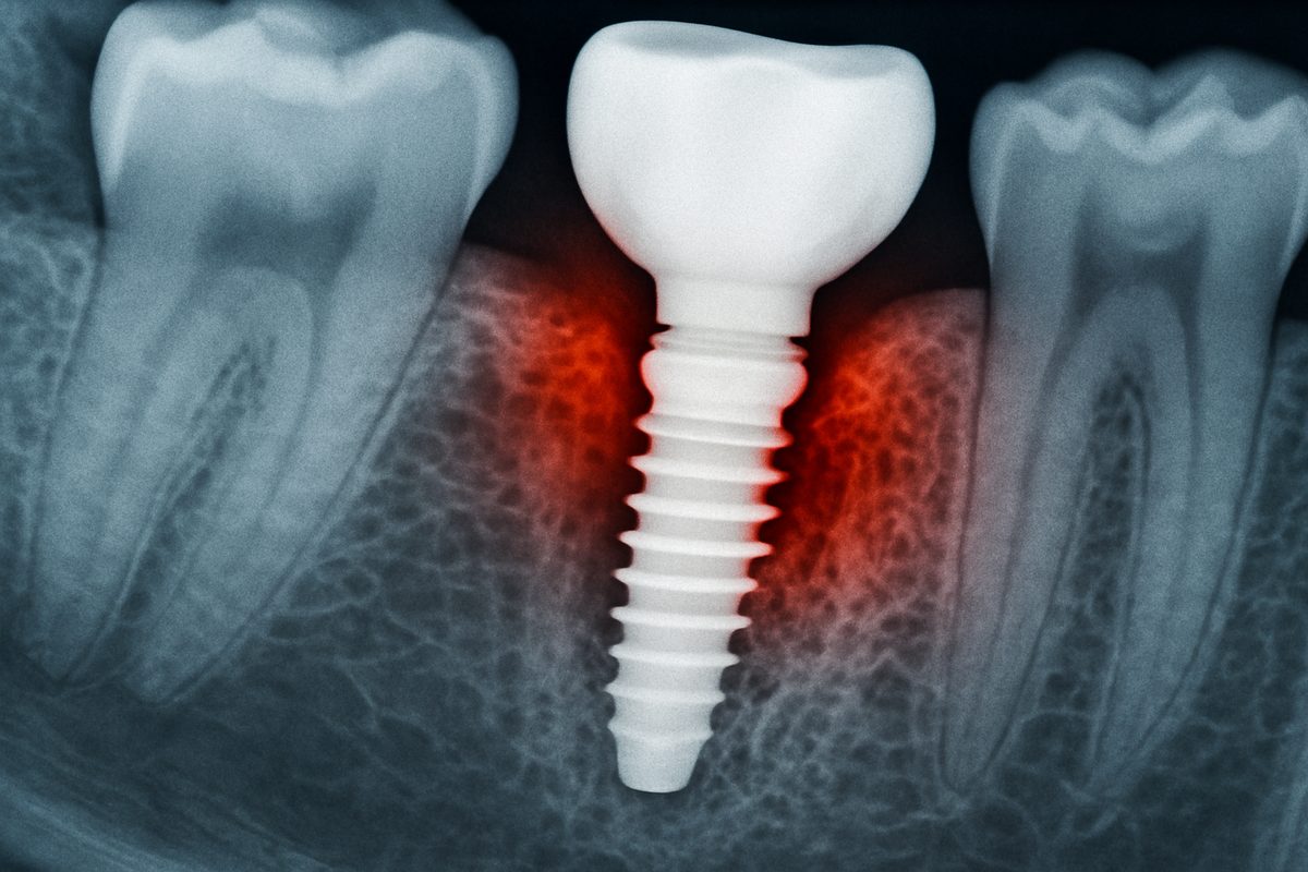 Close up X-Ray of an implant back tooth with bone loss and inflammation around the implant. No text on image.