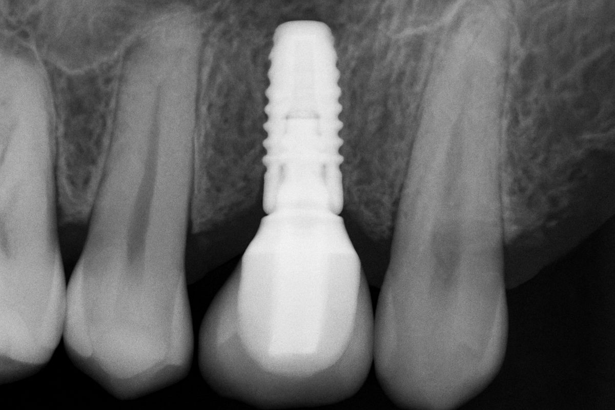 Close up x-ray of a single tooth implant screw integrated into a jaw bone. No text on image.