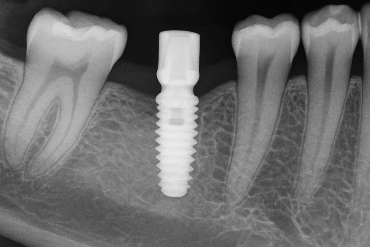 An x-ray image showing a missing tooth replaced by a dental implant. The dental implant is securely anchored in the jawbone. No text on image.